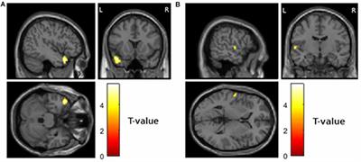 Cross-Sectional and Longitudinal Relationships between Depressive Symptoms and Brain Atrophy in MS Patients